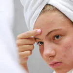 Čo nerobiť ak vás trápi akné?